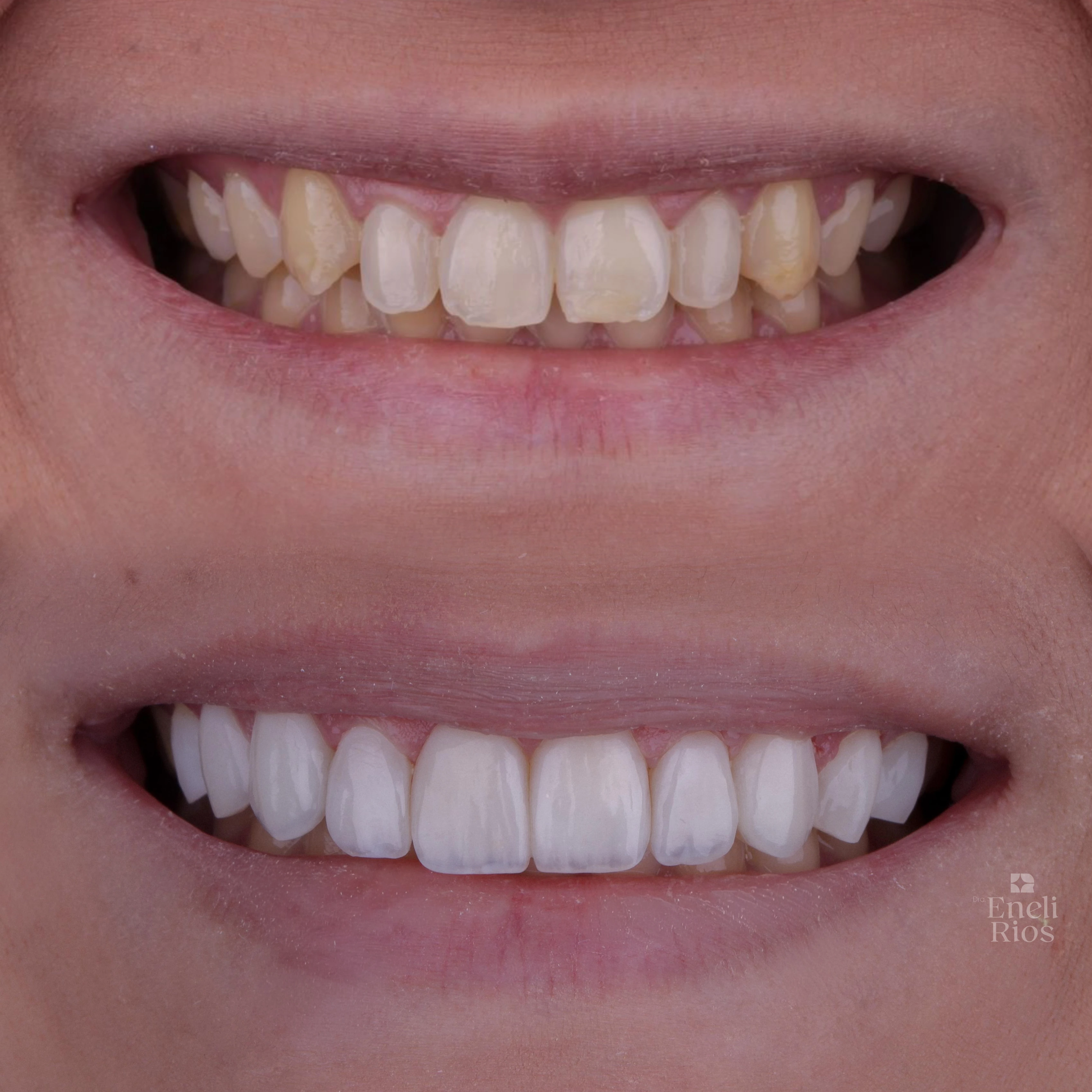 Caso de reabilitação estética
