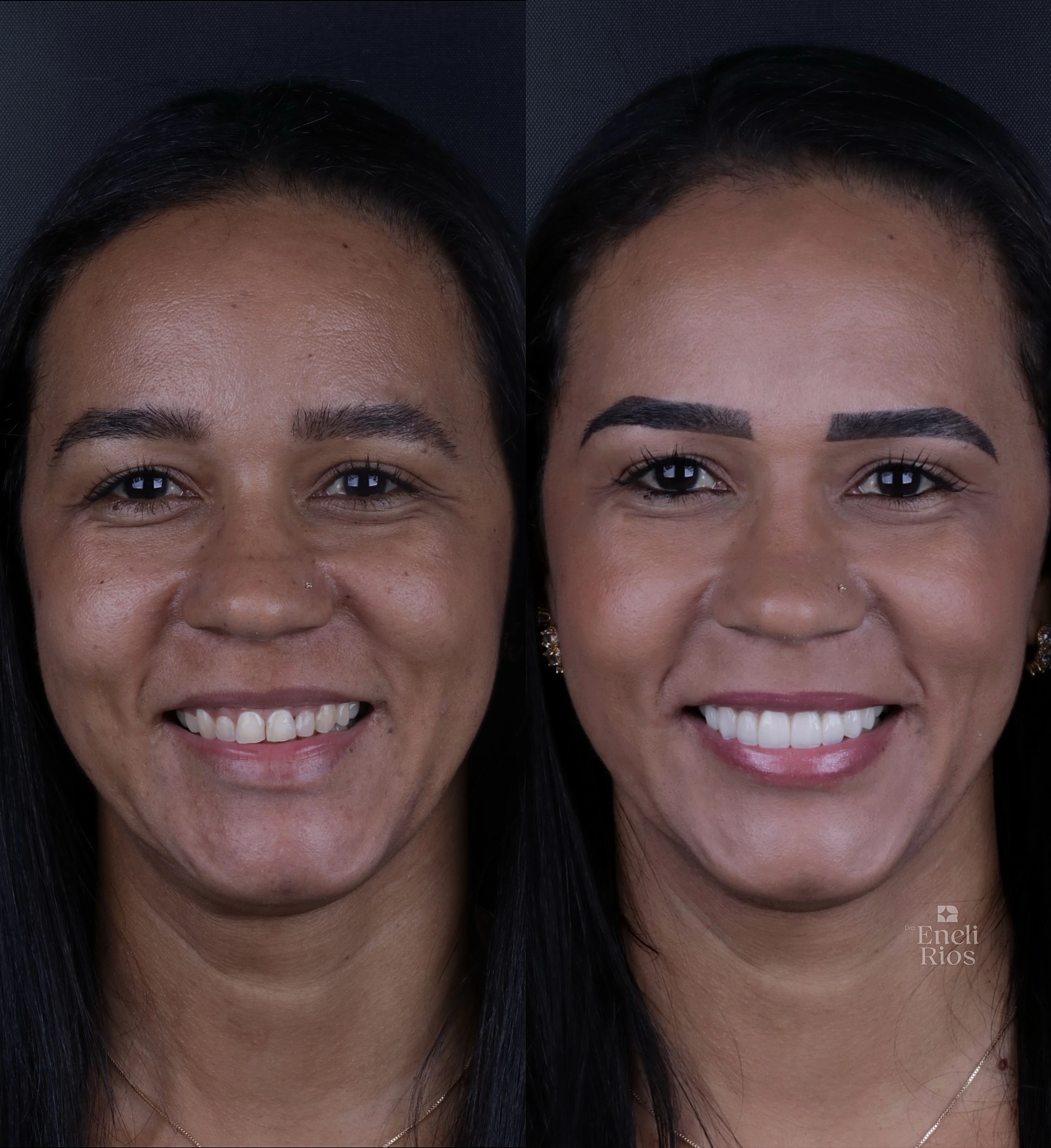 Resultado real de reabilitação estética