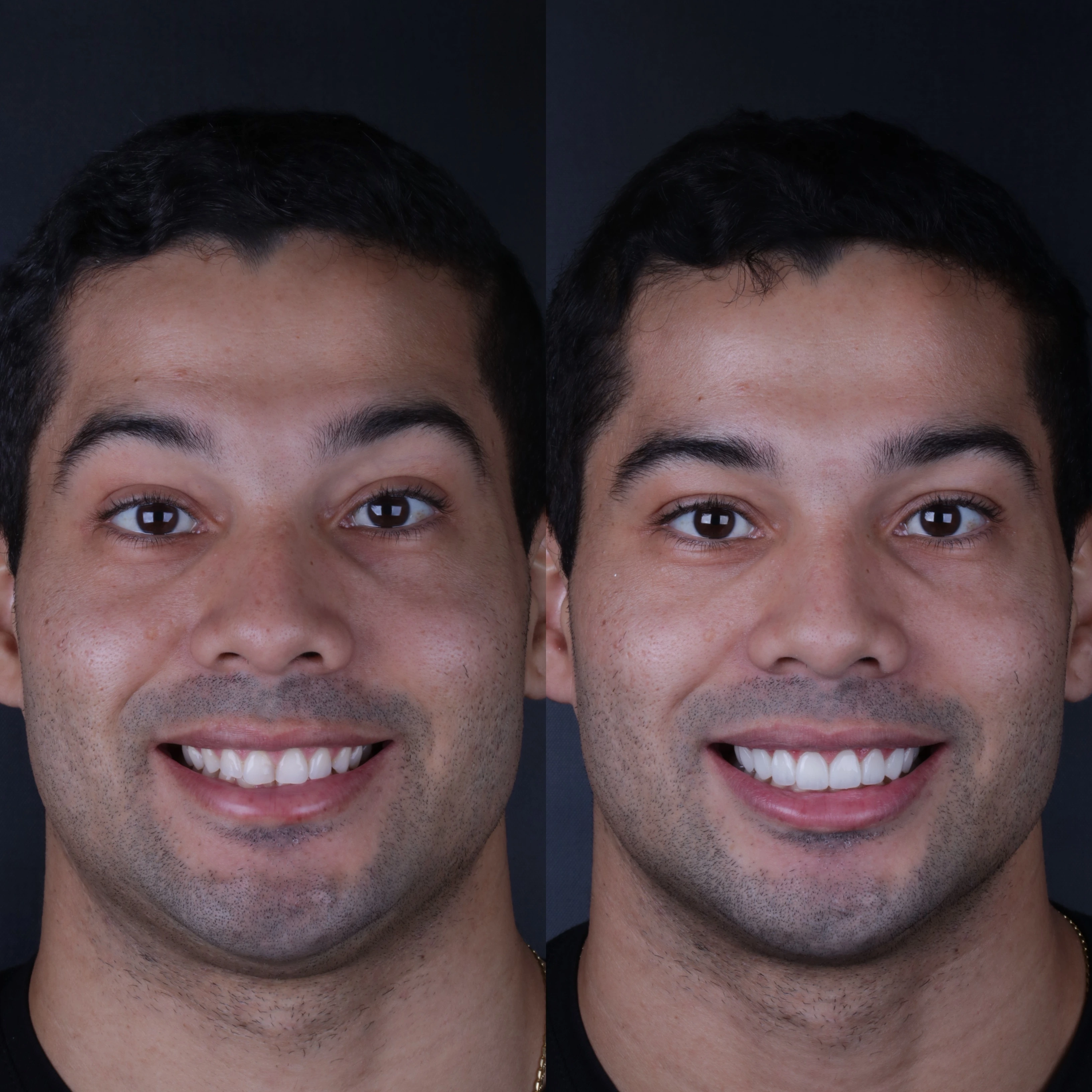 Resultado real de transformação do sorriso