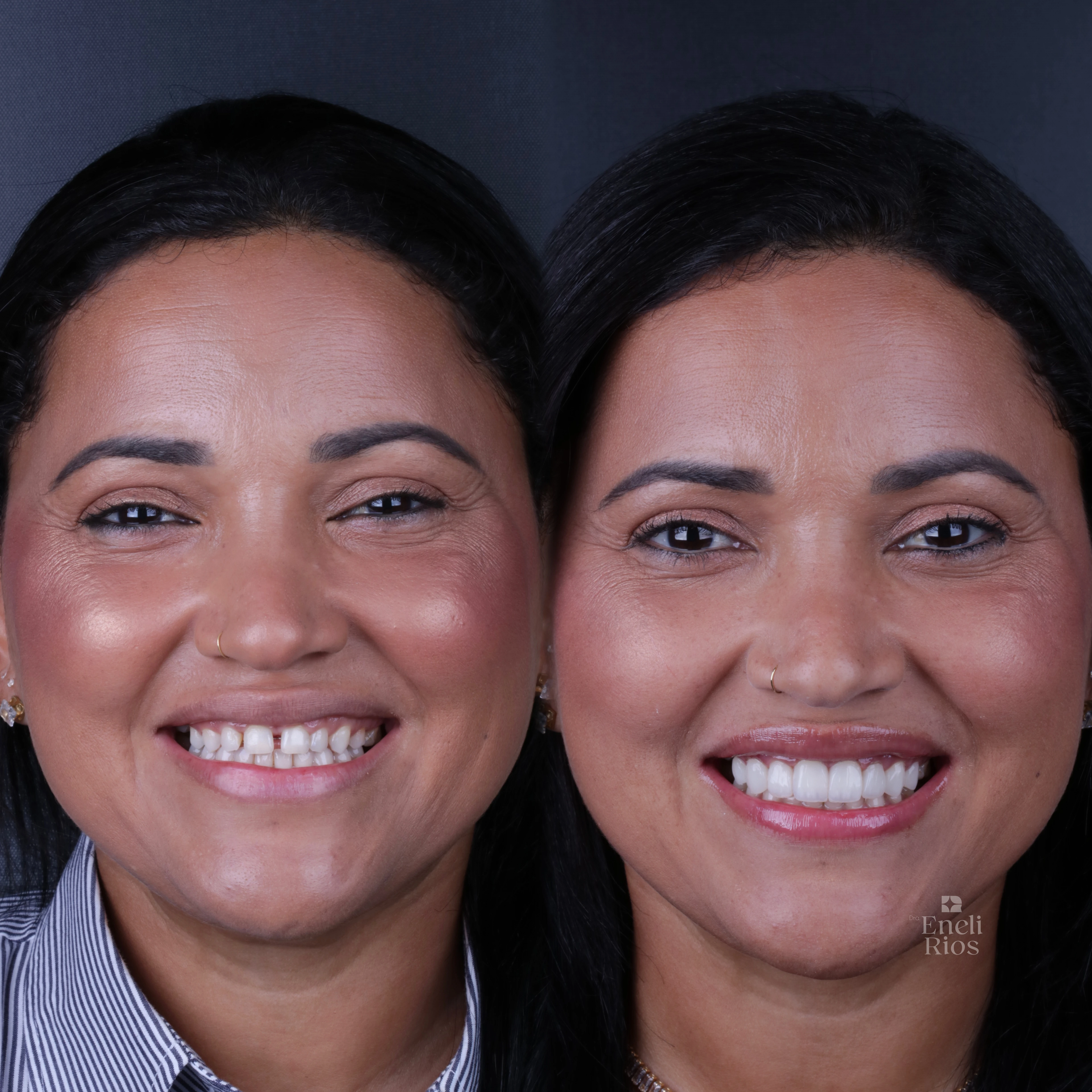 Resultado real de facetas em resina