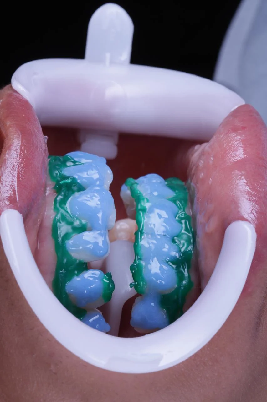 Clareamento dental