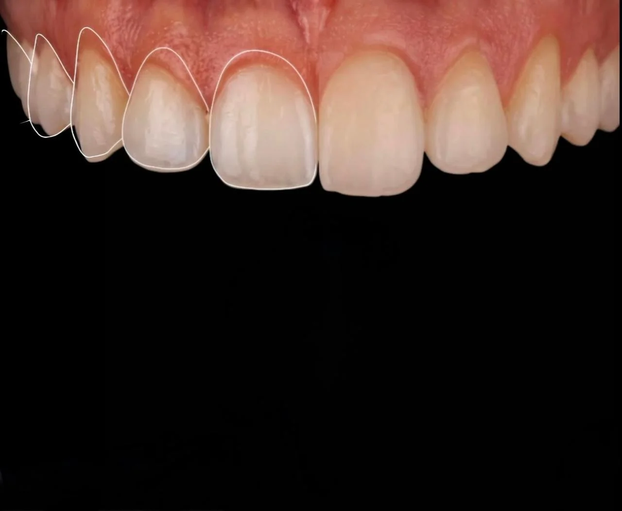 Resultado de gengivoplastia
