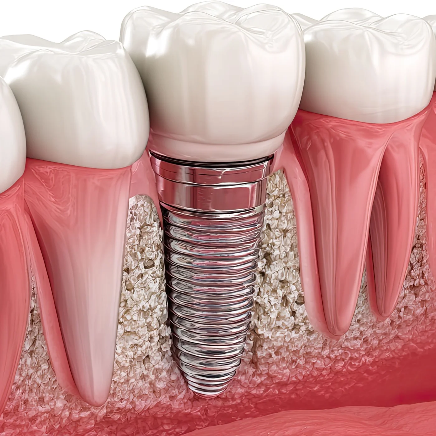 Implante dentário